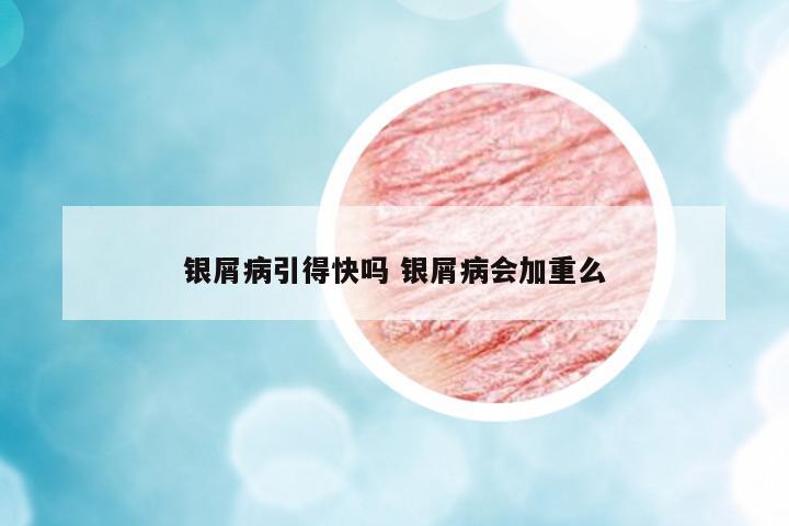 銀屑病引得快嗎 銀屑病會(huì)加重么