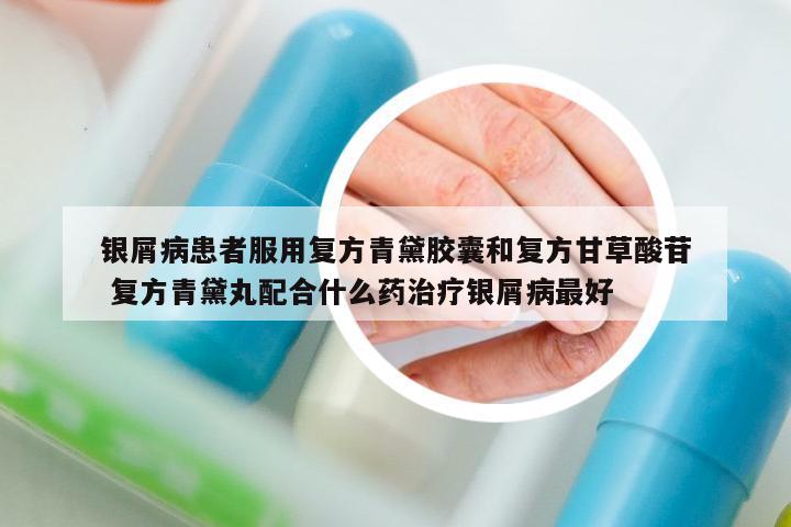 銀屑病患者服用復(fù)方青黛膠囊和復(fù)方甘草酸苷 復(fù)方青黛丸配合什么藥治療銀屑病最好