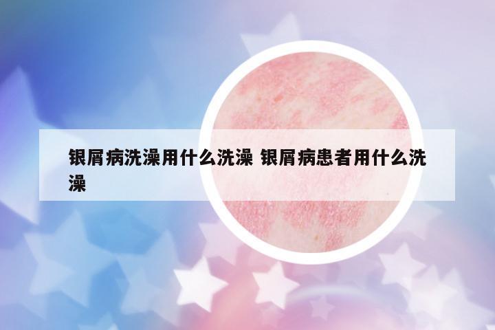 銀屑病洗澡用什么洗澡 銀屑病患者用什么洗澡