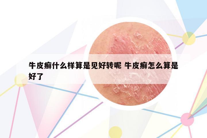 牛皮癬什么樣算是見好轉(zhuǎn)呢 牛皮癬怎么算是好了