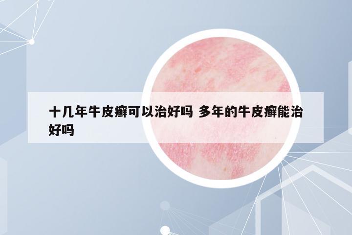 十幾年牛皮癬可以治好嗎 多年的牛皮癬能治好嗎