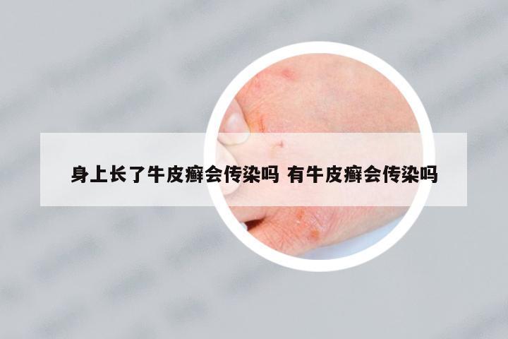 身上長(zhǎng)了牛皮癬會(huì)傳染嗎 有牛皮癬會(huì)傳染嗎