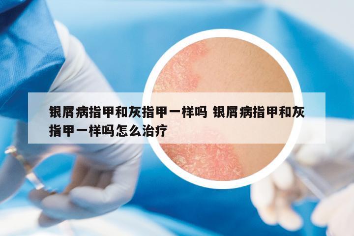 銀屑病指甲和灰指甲一樣嗎 銀屑病指甲和灰指甲一樣嗎怎么治療