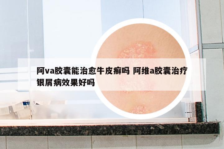 阿va膠囊能治愈牛皮癬嗎 阿維a膠囊治療銀屑病效果好嗎