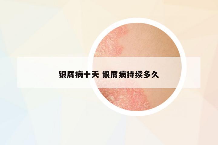 銀屑病十天 銀屑病持續(xù)多久