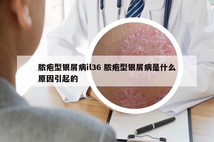 膿皰型銀屑病il36 膿皰型銀屑病是什么原因引起的