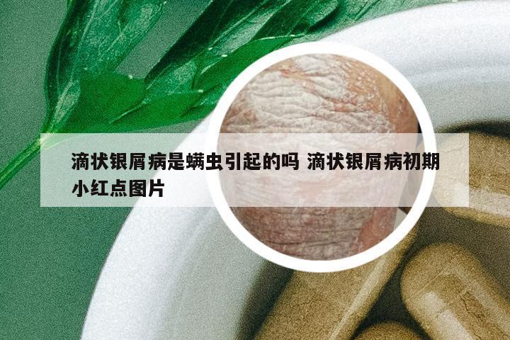 滴狀銀屑病是螨蟲引起的嗎 滴狀銀屑病初期小紅點(diǎn)圖片