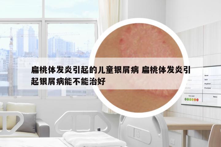扁桃體發(fā)炎引起的兒童銀屑病 扁桃體發(fā)炎引起銀屑病能不能治好