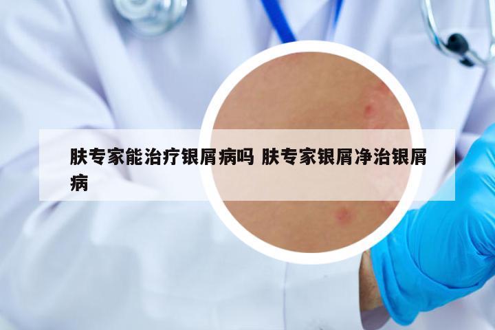 膚專家能治療銀屑病嗎 膚專家銀屑凈治銀屑病