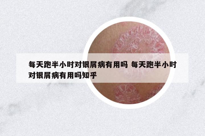 每天跑半小時對銀屑病有用嗎 每天跑半小時對銀屑病有用嗎知乎