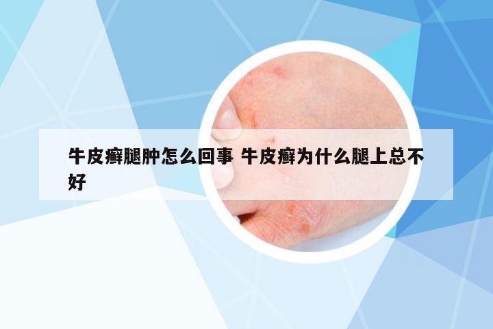 牛皮癬腿腫怎么回事 牛皮癬為什么腿上總不好