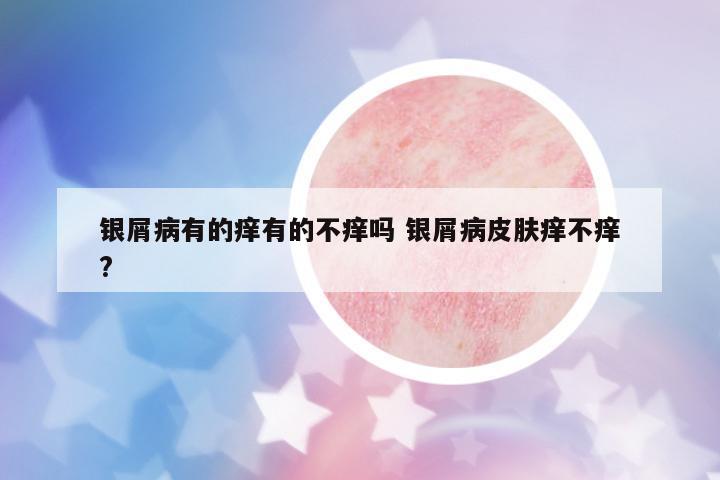 銀屑病有的癢有的不癢嗎 銀屑病皮膚癢不癢?