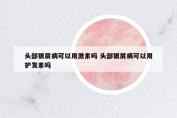 頭部銀屑病可以用激素嗎 頭部銀屑病可以用護(hù)發(fā)素嗎