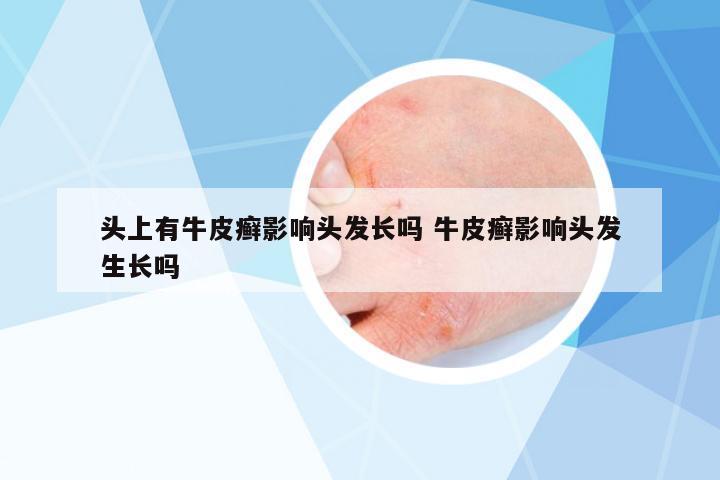 頭上有牛皮癬影響頭發(fā)長嗎 牛皮癬影響頭發(fā)生長嗎