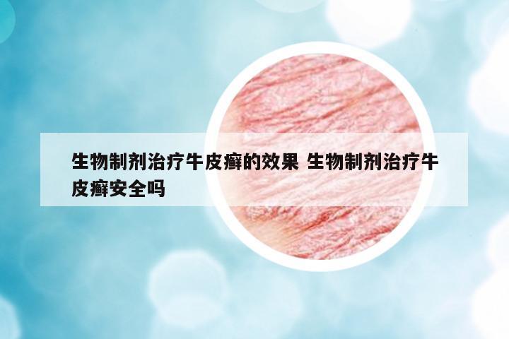 生物制劑治療牛皮癬的效果 生物制劑治療牛皮癬安全嗎