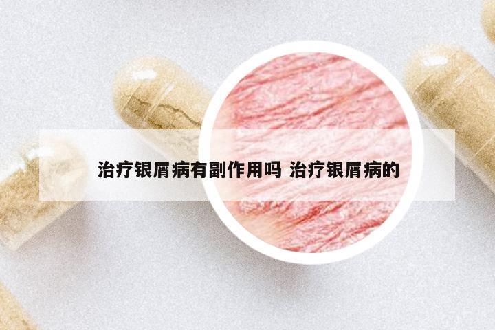 治療銀屑病有副作用嗎 治療銀屑病的