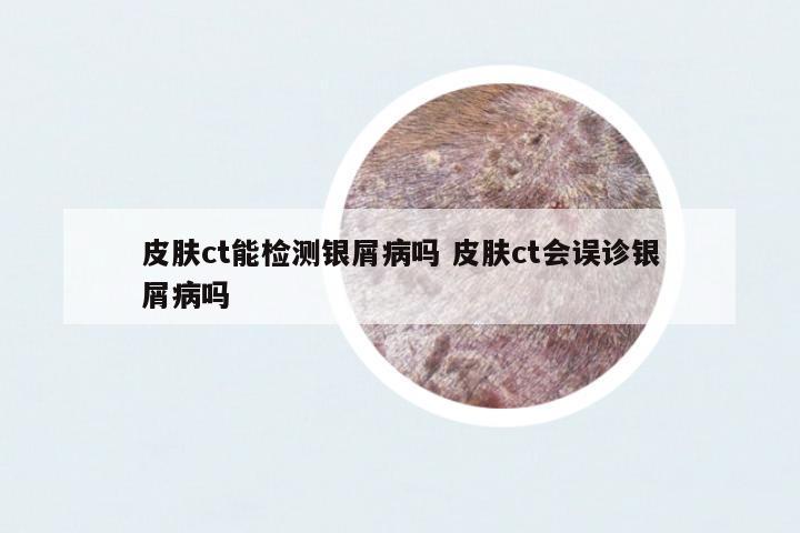 皮膚ct能檢測銀屑病嗎 皮膚ct會(huì)誤診銀屑病嗎