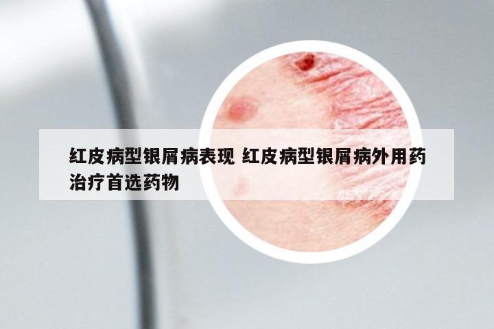 紅皮病型銀屑病表現(xiàn) 紅皮病型銀屑病外用藥治療首選藥物