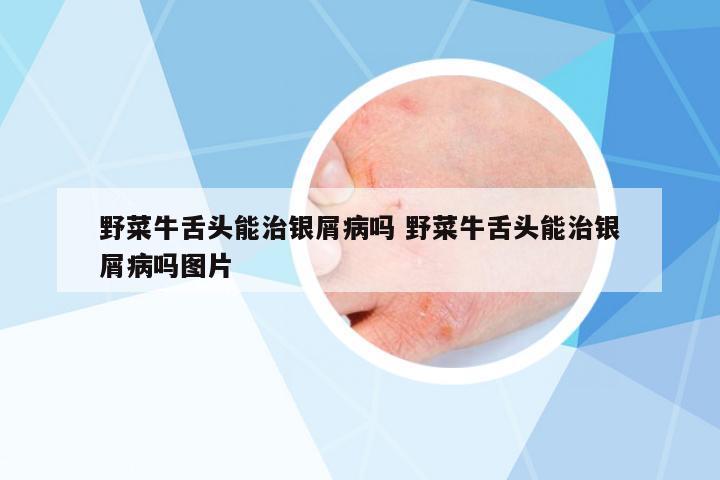 野菜牛舌頭能治銀屑病嗎 野菜牛舌頭能治銀屑病嗎圖片