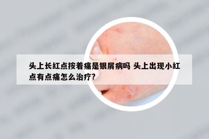 頭上長紅點(diǎn)按著痛是銀屑病嗎 頭上出現(xiàn)小紅點(diǎn)有點(diǎn)痛怎么治療?