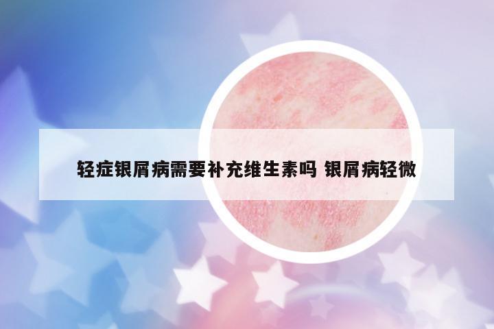 輕癥銀屑病需要補(bǔ)充維生素嗎 銀屑病輕微