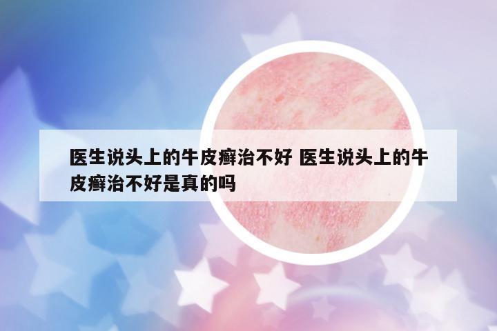 醫(yī)生說頭上的牛皮癬治不好 醫(yī)生說頭上的牛皮癬治不好是真的嗎