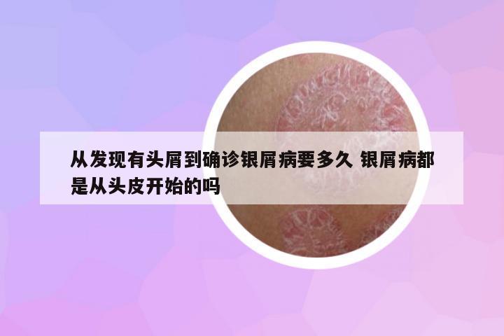 從發(fā)現(xiàn)有頭屑到確診銀屑病要多久 銀屑病都是從頭皮開始的嗎