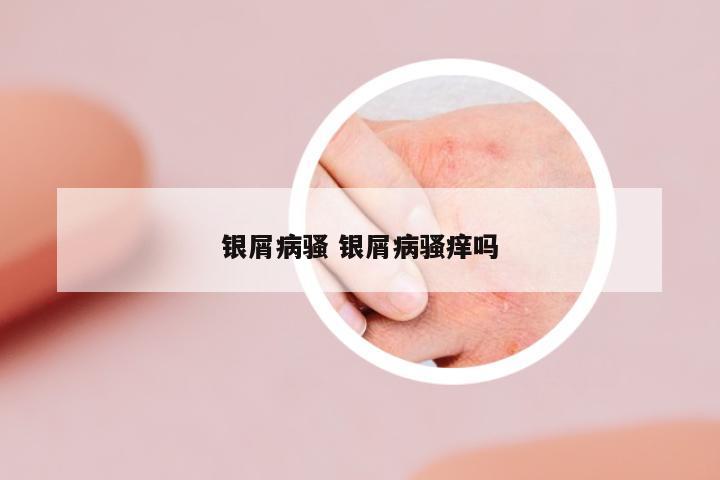 銀屑病騷 銀屑病騷癢嗎