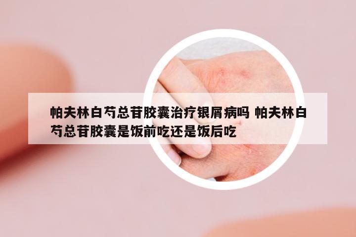 帕夫林白芍總苷膠囊治療銀屑病嗎 帕夫林白芍總苷膠囊是飯前吃還是飯后吃