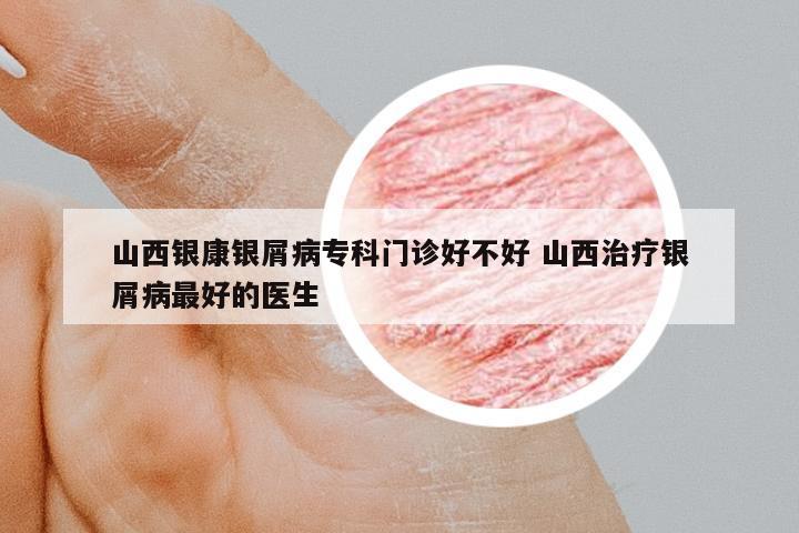 山西銀康銀屑病專(zhuān)科門(mén)診好不好 山西治療銀屑病最好的醫(yī)生