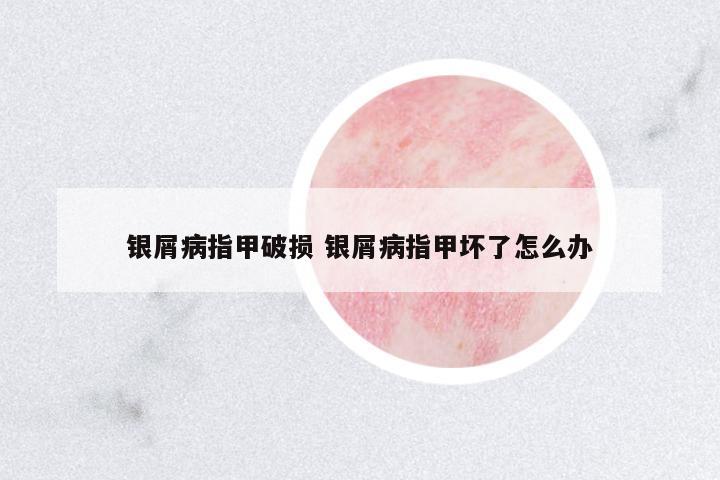 銀屑病指甲破損 銀屑病指甲壞了怎么辦