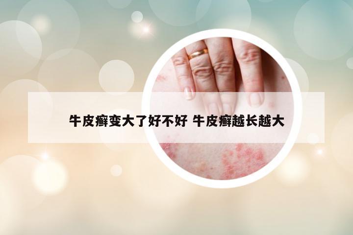 牛皮癬變大了好不好 牛皮癬越長越大