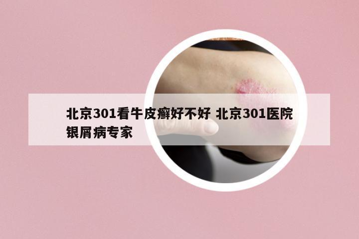 北京301看牛皮癬好不好 北京301醫(yī)院銀屑病專家