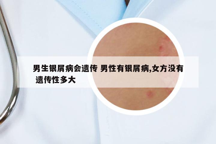 男生銀屑病會遺傳 男性有銀屑病,女方沒有 遺傳性多大