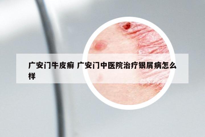 廣安門牛皮癬 廣安門中醫(yī)院治療銀屑病怎么樣