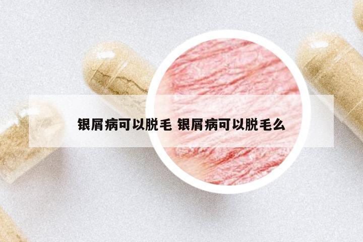 銀屑病可以脫毛 銀屑病可以脫毛么
