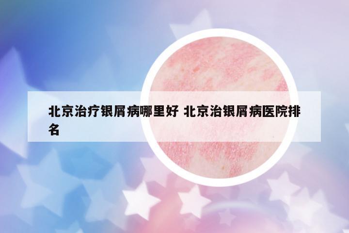 北京治療銀屑病哪里好 北京治銀屑病醫(yī)院排名