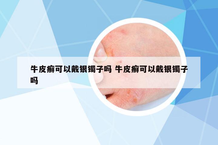 牛皮癬可以戴銀鐲子嗎 牛皮癬可以戴銀鐲子嗎