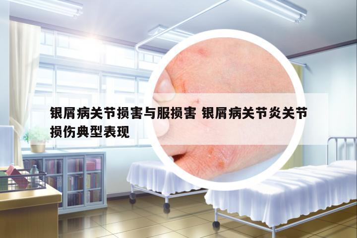 銀屑病關節(jié)損害與服損害 銀屑病關節(jié)炎關節(jié)損傷典型表現(xiàn)