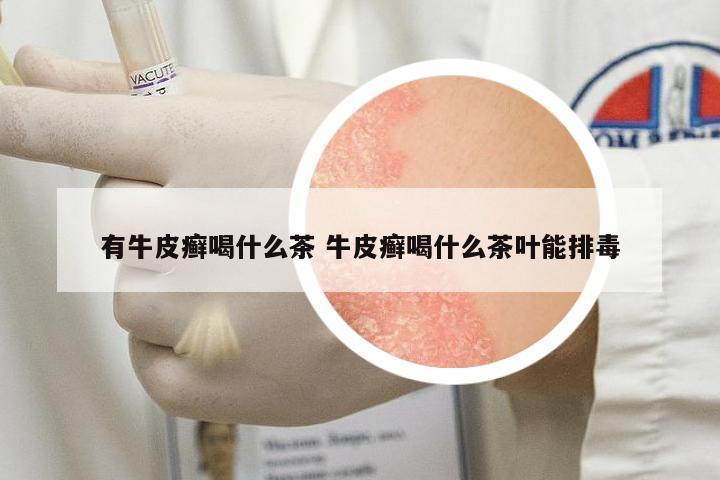有牛皮癬喝什么茶 牛皮癬喝什么茶葉能排毒