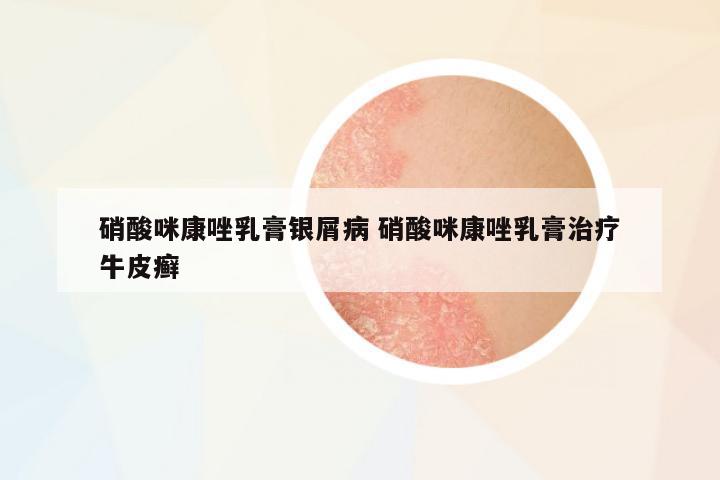 硝酸咪康唑乳膏銀屑病 硝酸咪康唑乳膏治療牛皮癬