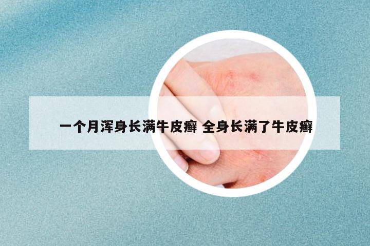 一個月渾身長滿牛皮癬 全身長滿了牛皮癬