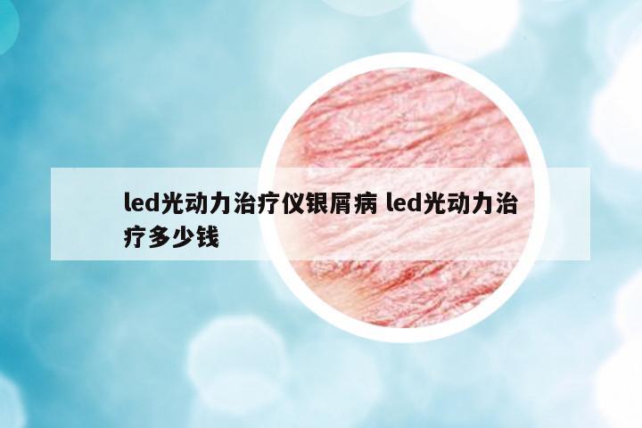 led光動力治療儀銀屑病 led光動力治療多少錢