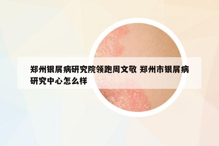 鄭州銀屑病研究院領(lǐng)跑周文敬 鄭州市銀屑病研究中心怎么樣