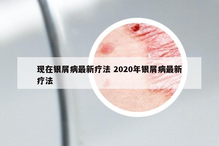 現(xiàn)在銀屑病最新療法 2020年銀屑病最新療法