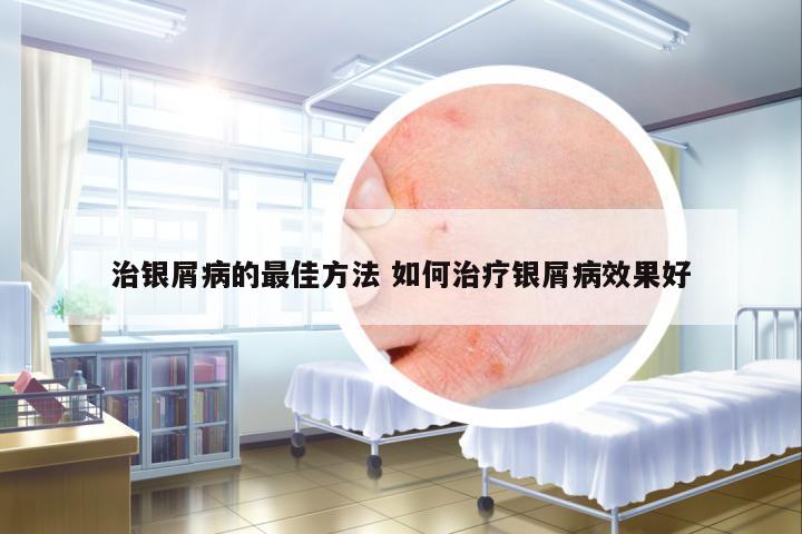 治銀屑病的最佳方法 如何治療銀屑病效果好