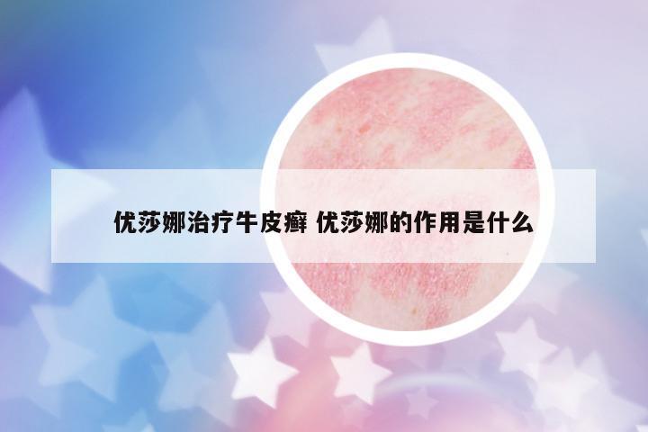 優(yōu)莎娜治療牛皮癬 優(yōu)莎娜的作用是什么