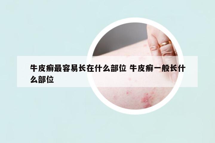 牛皮癬最容易長(zhǎng)在什么部位 牛皮癬一般長(zhǎng)什么部位