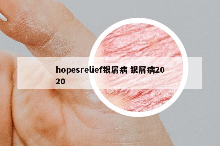 hopesrelief銀屑病 銀屑病2020
