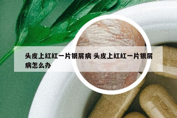 頭皮上紅紅一片銀屑病 頭皮上紅紅一片銀屑病怎么辦